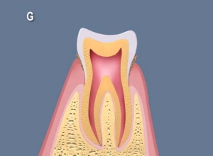 歯肉炎（初期段階の歯周病）