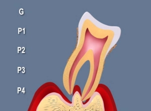 末期の歯周炎