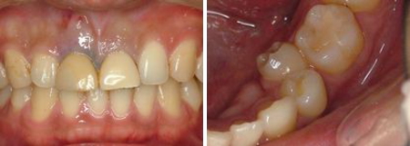 左：治療前　右：歯並びの悪い歯を抜歯